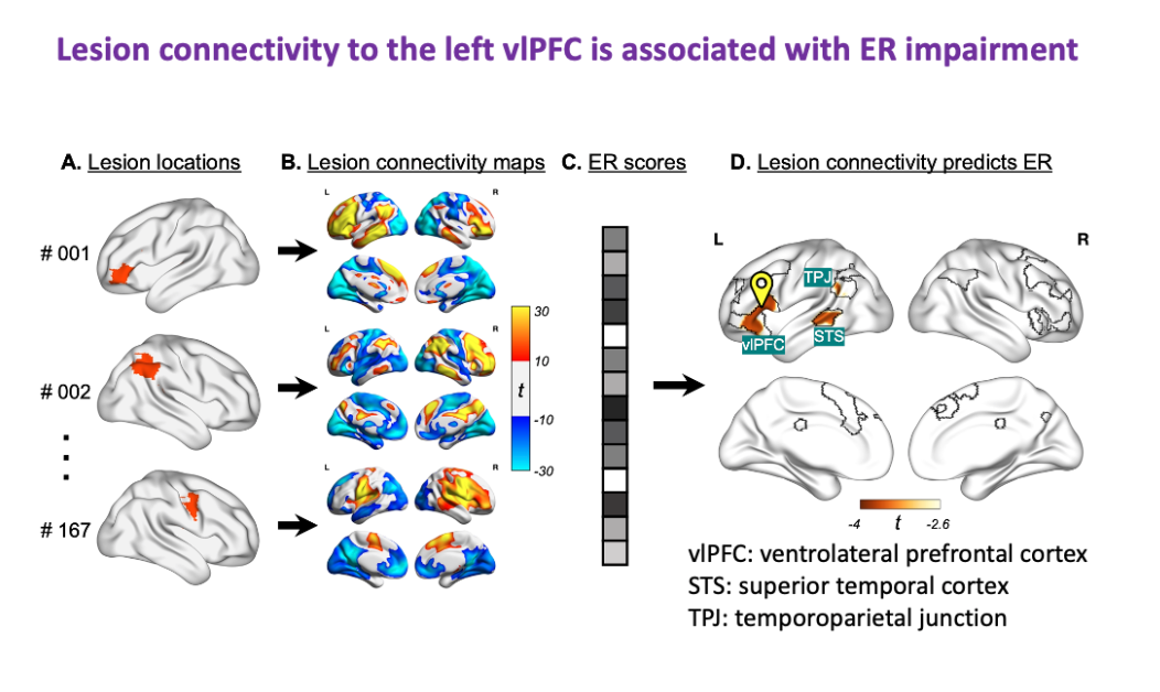 Lesion connectivity to the left vIPFC is associated with ER